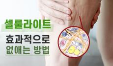 셀룰라이트 없애는 방법 (치료, 생기는 이유 등)