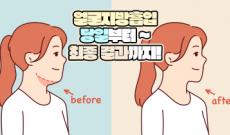 얼굴지방흡입 당일부터 최종 결과까지