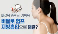버팔로 험프 지방흡입으로 해결 가능할까? (버섯목 증후군, 거북목)