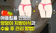 애플힙 만들기, 엉덩이 지방이식과 관리 방법