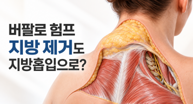 버팔로 험프 지방 제거도 지방흡입으로 할 수 있나요?