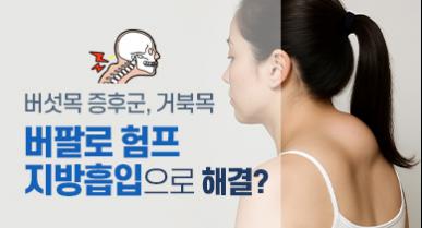 버팔로 험프 지방흡입으로 해결 가능할까? (버섯목 증후군, 거북목)
