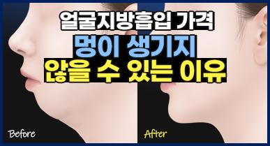 얼굴지방흡입 가격과 멍이 생기지 않을 수 있는 이유