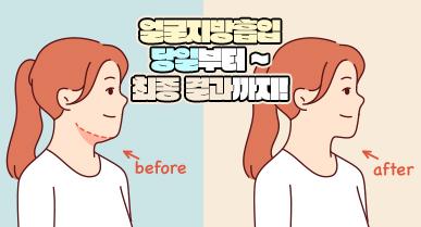 얼굴지방흡입 당일부터 최종 결과까지