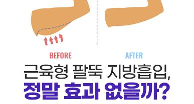 근육형이면 팔뚝지방흡입 효과가 없나요?