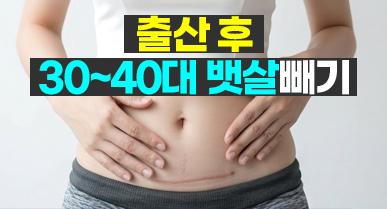 뱃살지방흡입 가격, 출산 후 30~40대 뱃살빼기