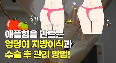 애플힙 만들기, 엉덩이 지방이식과 관리 방법