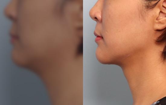 3개월 후/165cm/59kg/100cc