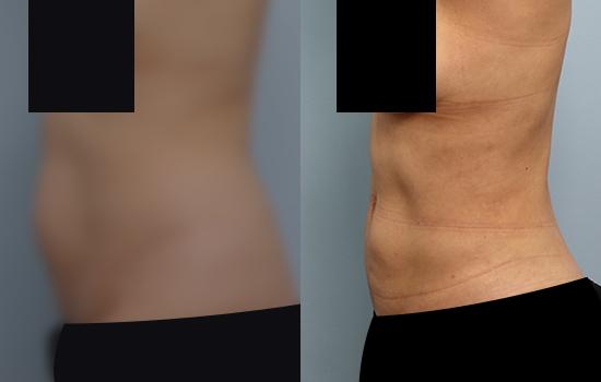 2개월 후/158cm/59kg/2700cc