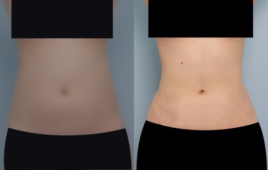 3개월 후/161cm/54kg/2300cc