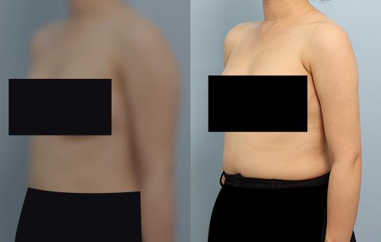 4개월 후/163cm/58.6kg/1000cc